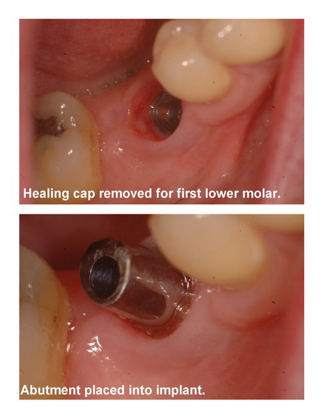 Implant seating pg 1 edited_resize.jpg